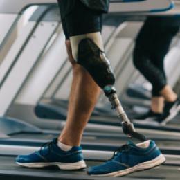 Photo of person with a prosthesis on the treadmill.